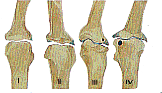 Evolutie osteoartrose: vingerkootjes