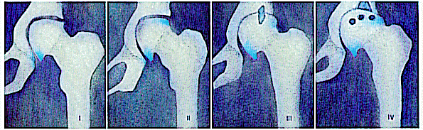 Evolutie osteoartrose: heupgewricht